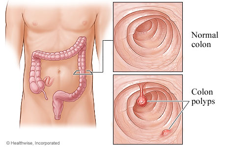 Bowel-Cancer-Screening