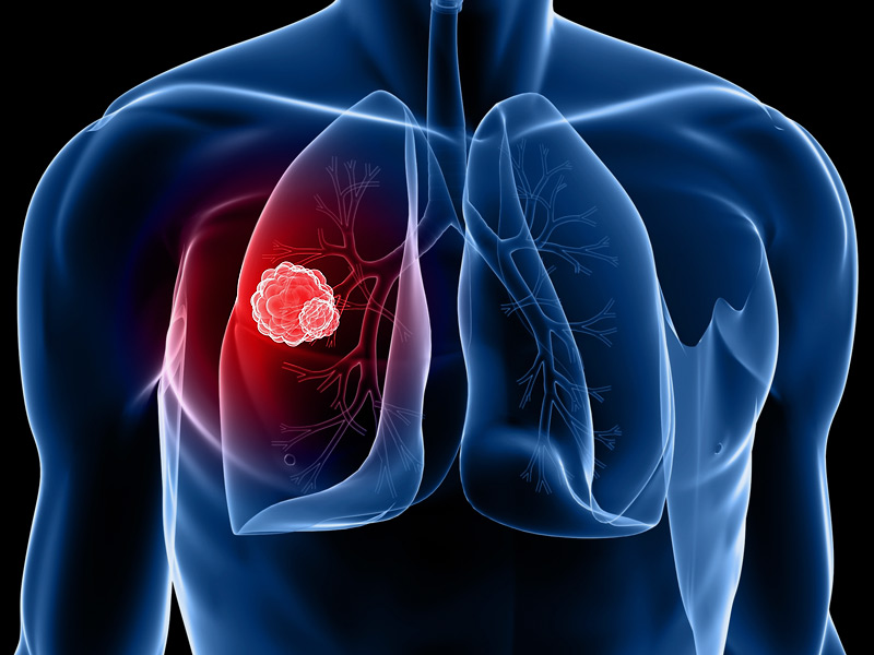 CT-screening-for-lung-cancer