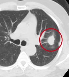 CT-screening-for-lung-cancer-2