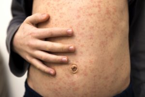 measles rush on stomach