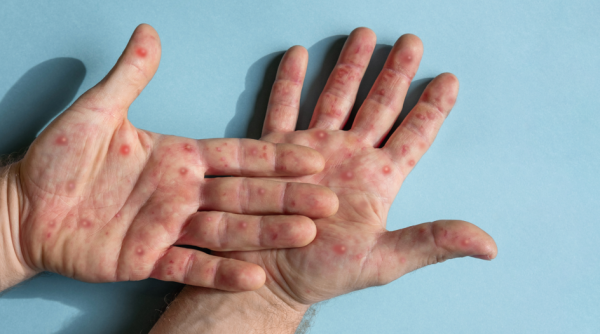 two hands of someone with monkeypox 