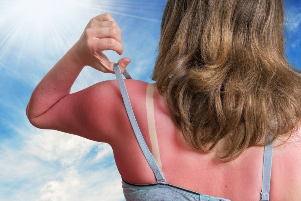 Young woman with burnt shoulders from behind